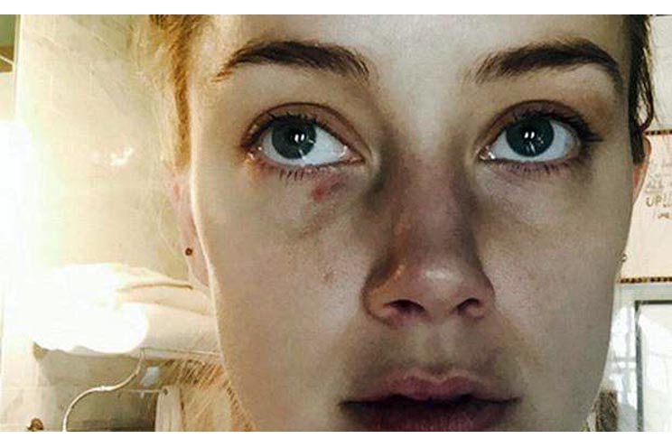 Fotos comprobarían maltrato de Johnny Depp a Amber Heard